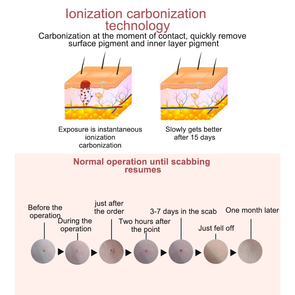Устройство для удаления кожных меток, портативное средство для удаления пятен от родинок, бородавок, кукурузы, инструмент для ухода за кожей, косметический инструмент