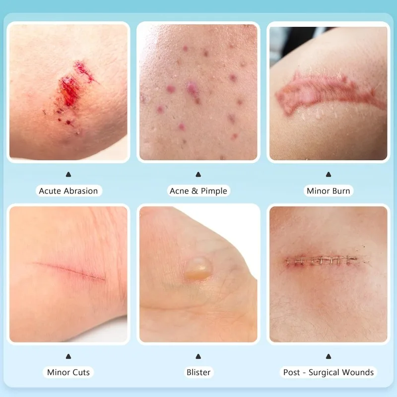 ضمادة الغروانية المائية للعناية بالجروح، مقاومة للماء، تحجيم وتشكيلها بنفسك، لفة تزيين الغروانية المائية #3