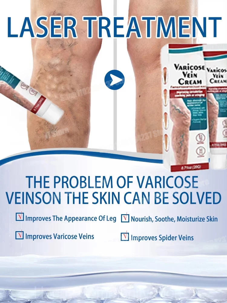 Varicose veins effectively alleviate lower limb vasculitis and improve circulation in patients with venous inflammation