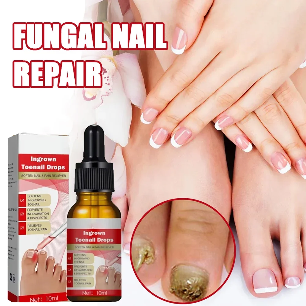 Extra Strong Nail Fungus Treatment Serum Essence oil Feet Nails Repair Care Essence Cream Anti Infection Toe Fungal Removal