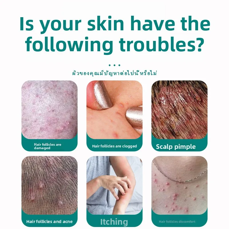 Suwangtiya Follicle Cream 30g - Complexo de 7 ervas do Yunnan para alívio profundo da coceira e calmante da pele, fórmula testada clínicamente