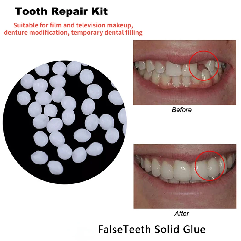 Pegamento de reparación Dental moldeable, huecos temporales Falseteeth sólidos, relleno roto Falseteeth, blanqueamiento, suministros dentales de seguridad, nuevo