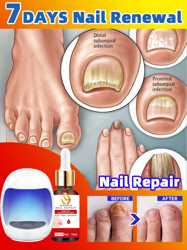 

Laser For Solving Feet Nail