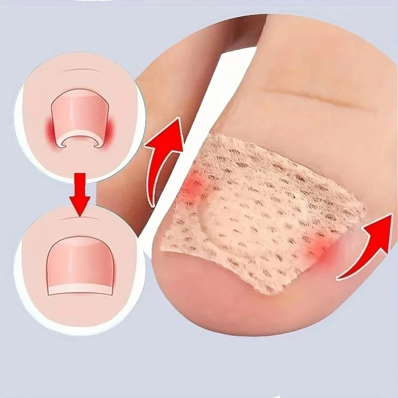 10pcs Ingrown Toenails Band Aid Relief Pain Paronychia Correction Pedicure Elastic Force Sticker Bandage Toe Nail