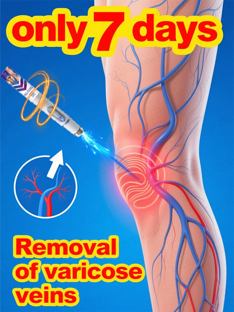 

Generation-2 Laser Says Goodbye To Spider Legs Varicose In 7 Days