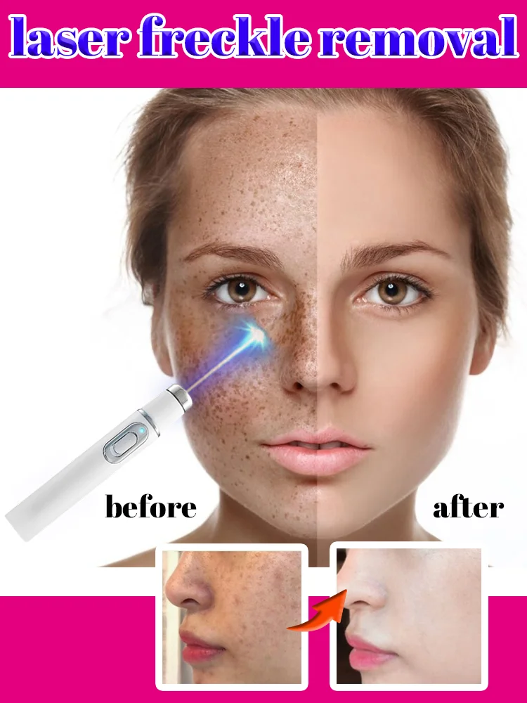 

Facial spots disappear Nano laser