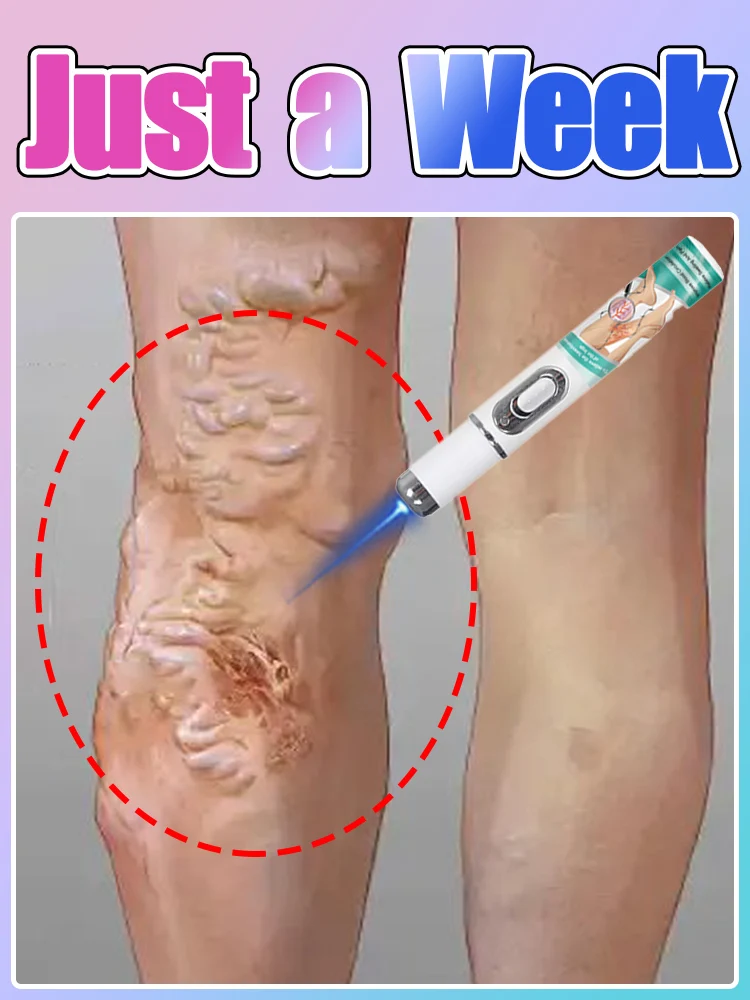 

2025 New Upgrade Blue laser Solve Vein Tool Spider legs