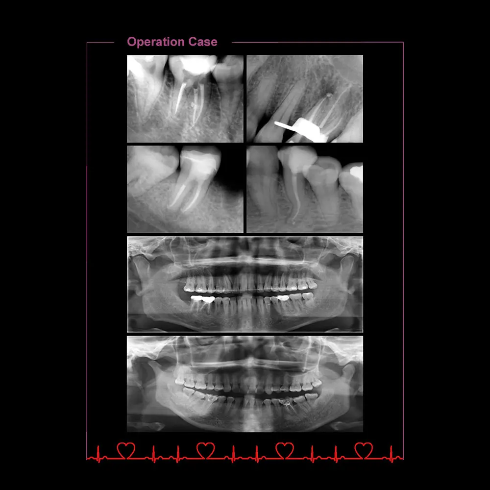 5 sztuk/paczka Dental Rotary Files 25/.04 25/.06 20/.07 15/.03 20/.04 pliki endodontyczne NITI używane do stomatologicznych instrumentów obrotowych