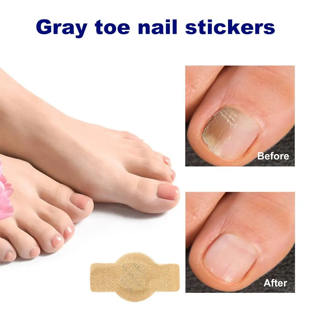 ไฮโดรเจลแพทช์เชื้อราเล็บเท้าสีเทาช่วยเพิ่มการติดเชื้อ การตรึง ป้องกันการคล่องตัว และส่งเสริมการเจริญเติบโตของเล็บใหม่