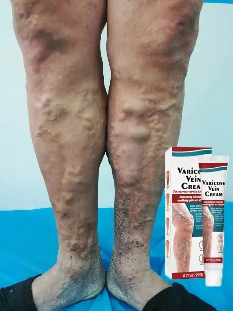 Crema para eliminar venas varicosas, tratamiento efectivo, Vasculitis, lombriz de tierra, araña, reparación del dolor de piernas, yeso, ungüento para aliviar la flebite