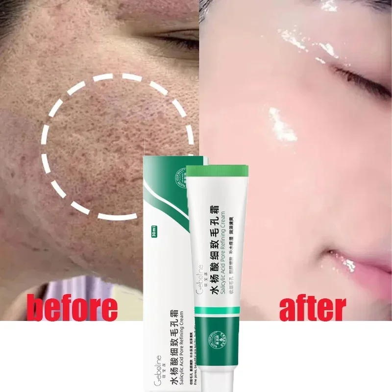 Crème de rétrécissement des pores à l'acide salicVAC, élimination rapide des grands pores, élimination des points noirs, resserrement du visage lisse, réparation, produits de soins pour la peau