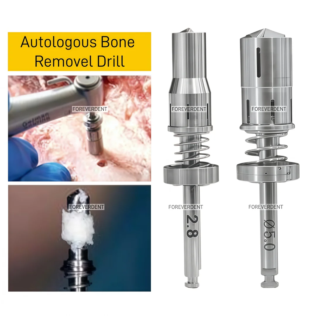 Dental Bonesier Autogeneous Bone Harvesting Drill Spring Bone Harvesting Drill Self-grinding Bone Powder Collection Drill