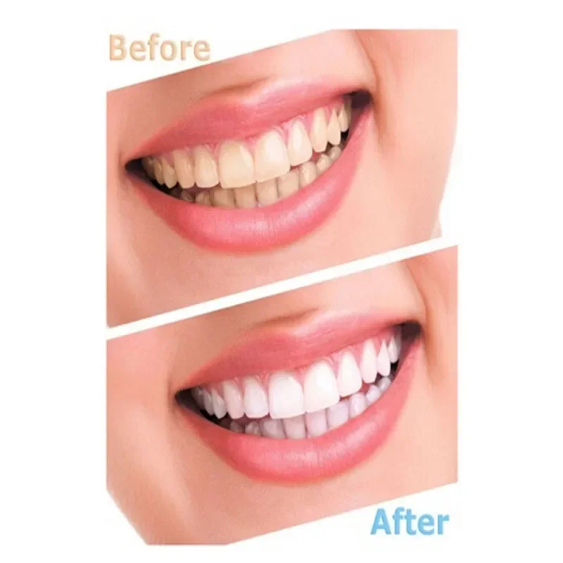 2 قطعة الحرس الليلي الشفاف لطحن الأسنان صريف الأسنان حماية النوم العلوي السفلي صواني الفم تبييض #6