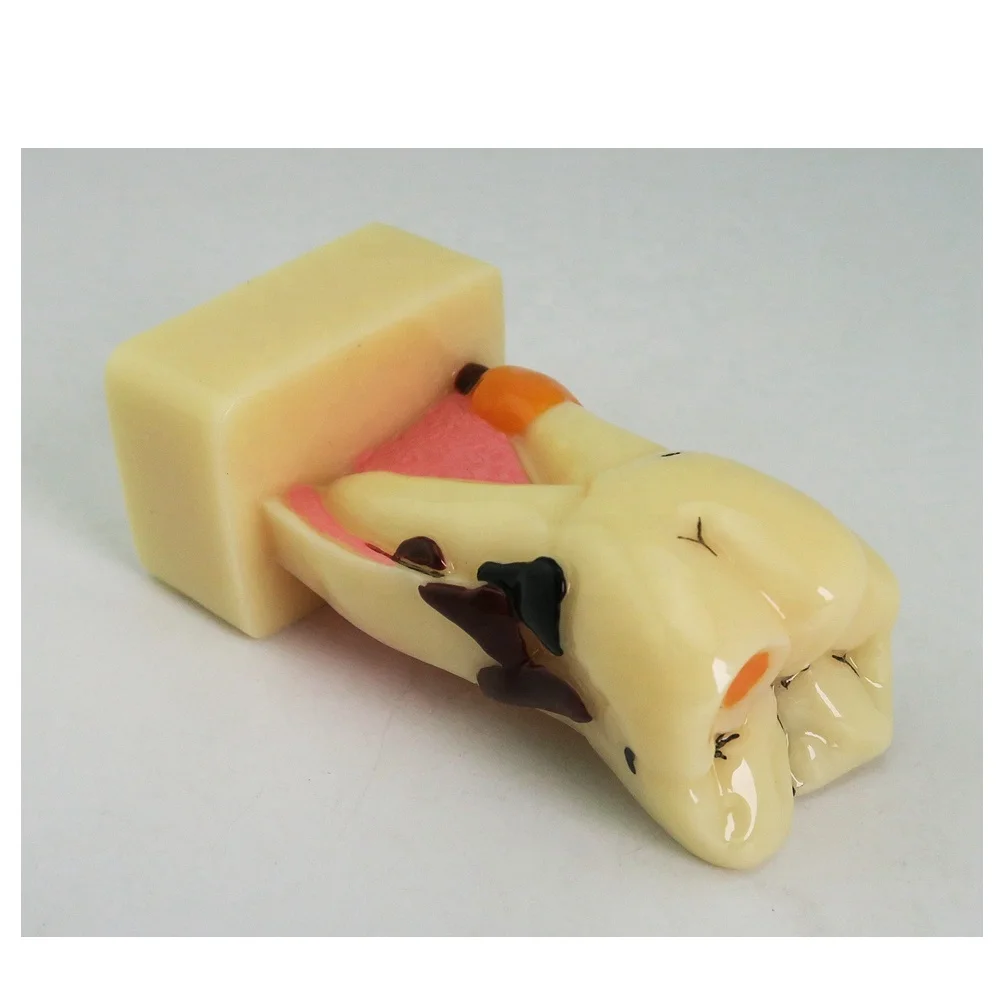 4-voudig Cariësdemonstratie Model Tandmodel