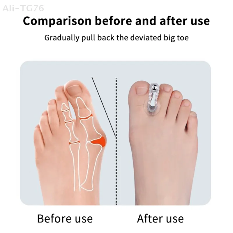 Corretor de joanete hálux valgus, separador de dedo do pé, alisador de correção de dedo, ferramenta de cuidados com os pés, uso confortável, 1 peça