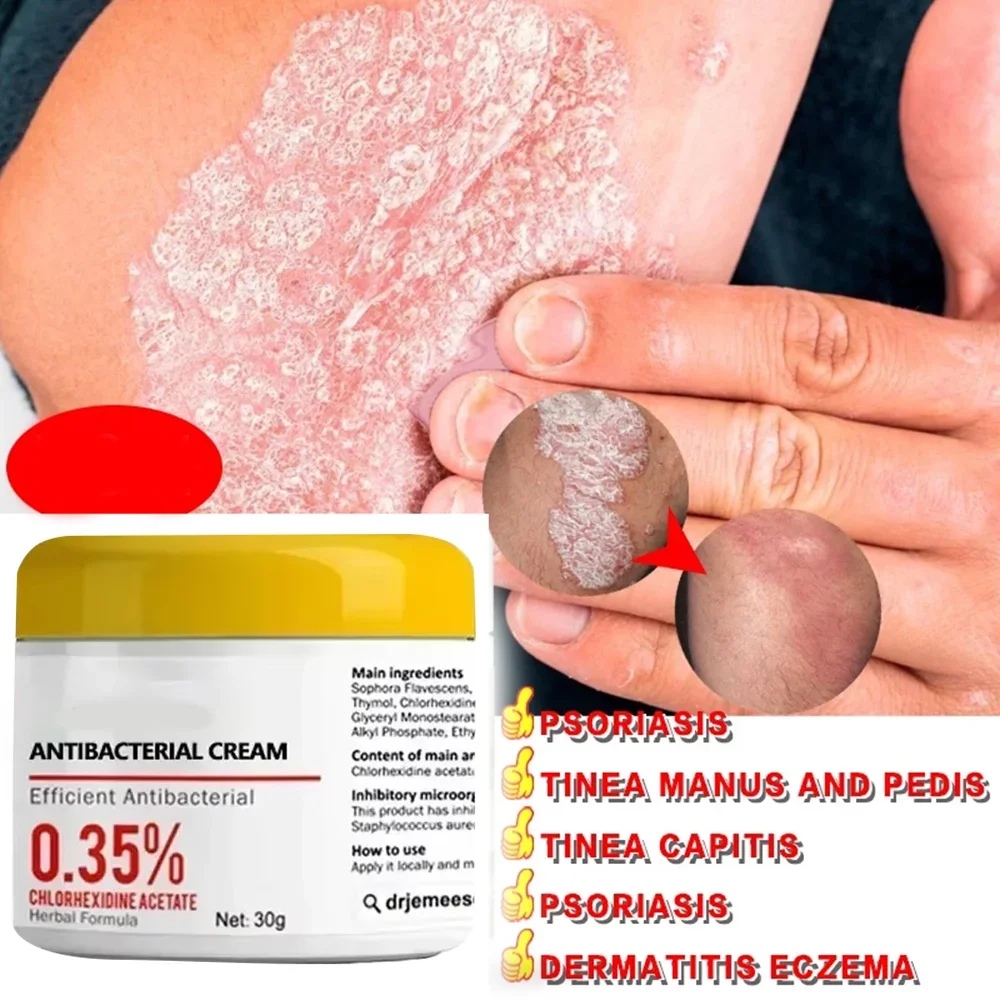 Сверхсиловой крем от псориаза для