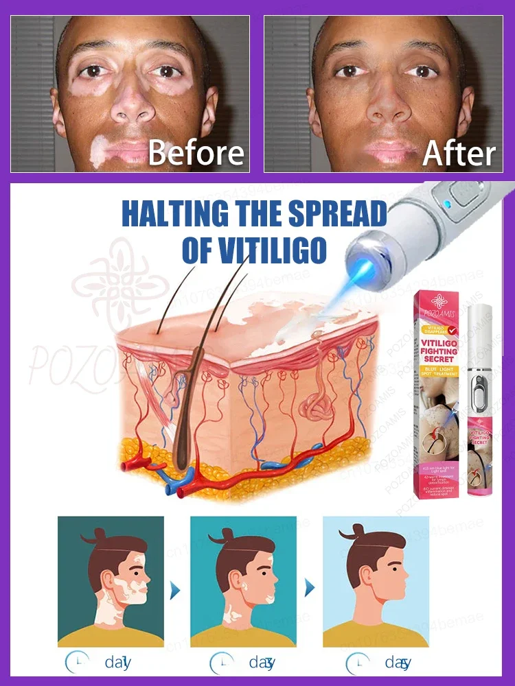 Vitiligo terapi Laser