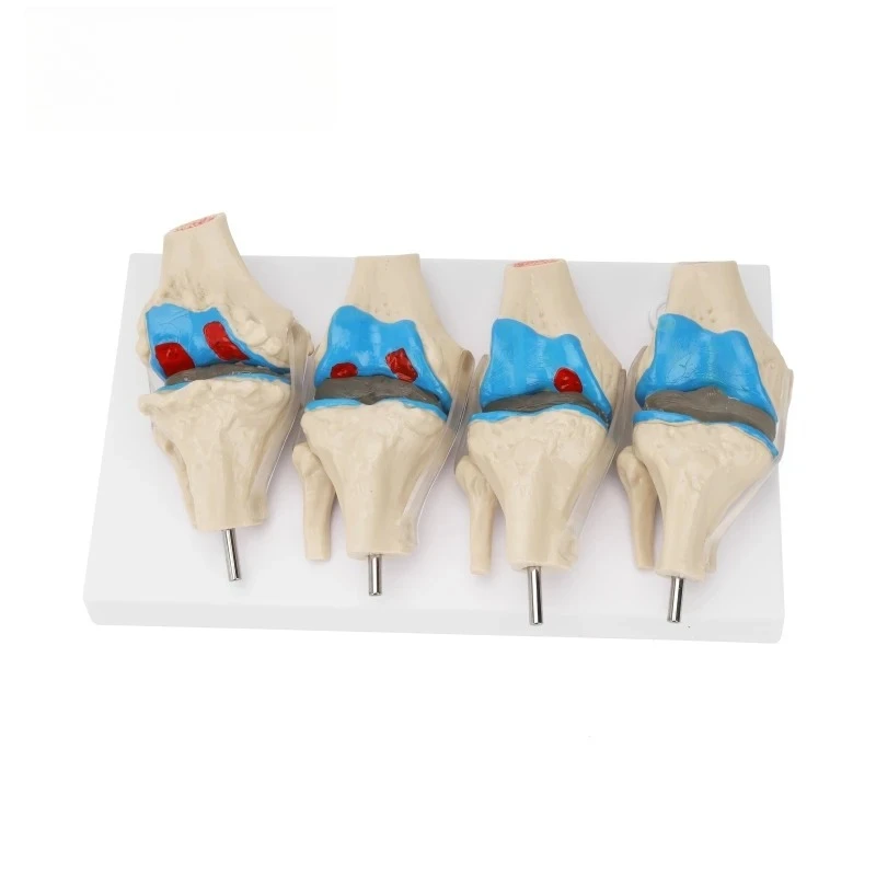 Human Knee Joint Pathological Model 4‑Stage Osteoarthritis Anatomical Demonstration Specimen for Medical Teaching Clinical