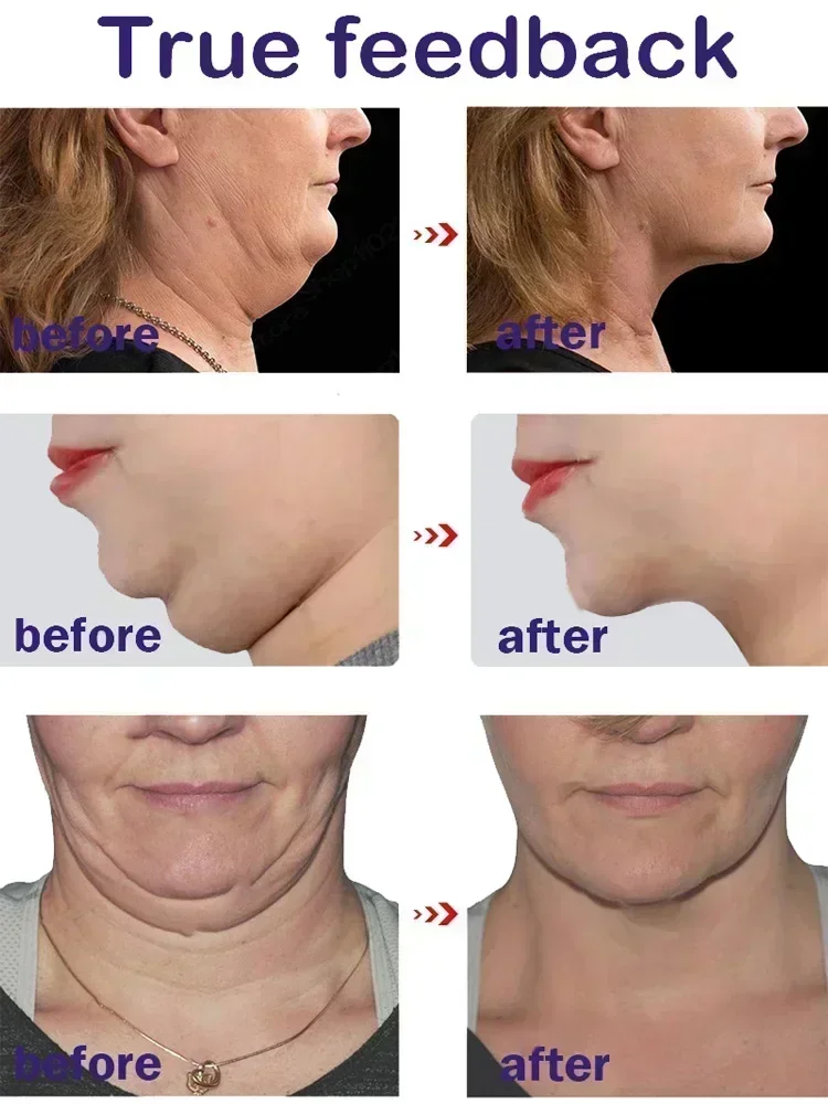 Schöne V-Form Straffende Facelift-Creme Entfernung Masseter Muskel Doppelkinn Gesicht Fettverbrennung Anti-Aging-Produkte