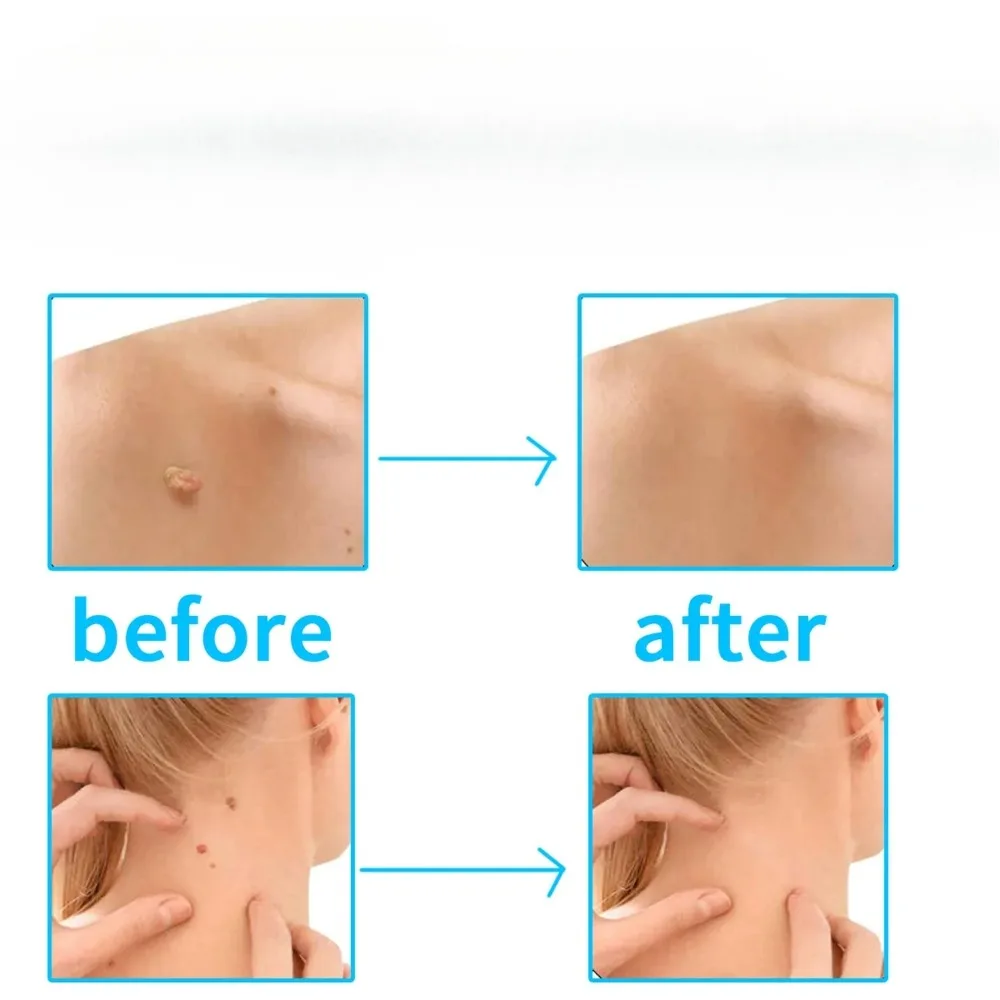 20 ชิ้น 1-4 มิลลิเมตร/5-8 มิลลิเมตรลบแท็กผิวหดสุขภาพความงาม Skin Care เครื่องมือแหวนยางปลอดสารพิษ: Removal Mole Wart Removal