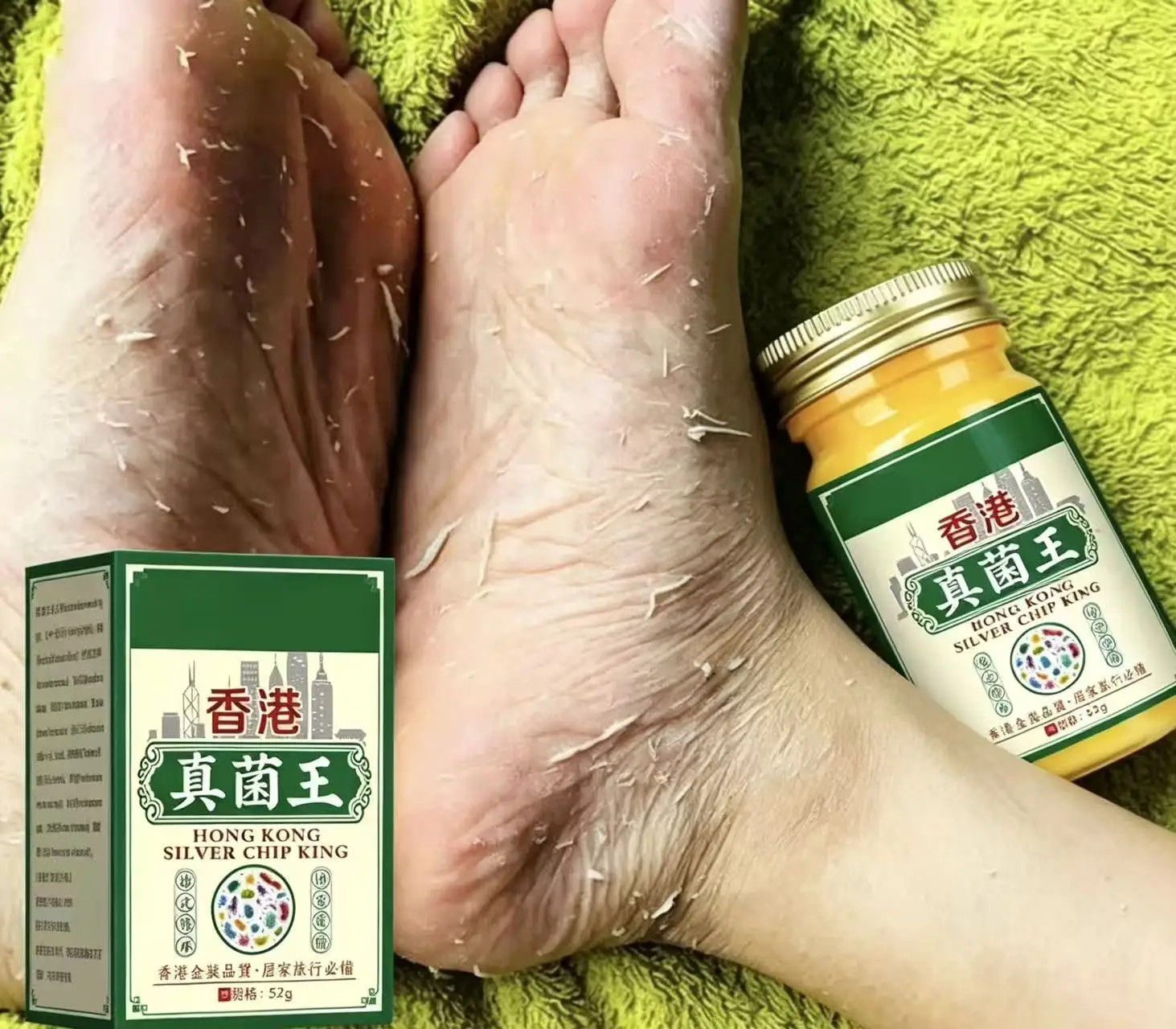 Hong Kong Fungus King Beriberi Foot Itch Foot Odor Foot Peeling Blister Foot Toe Seam Erosion Rotten Foot Bacteriostatic