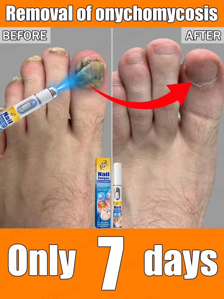 

Say goodbye to onychomycosis and avoid recurrence. Get normal nails again