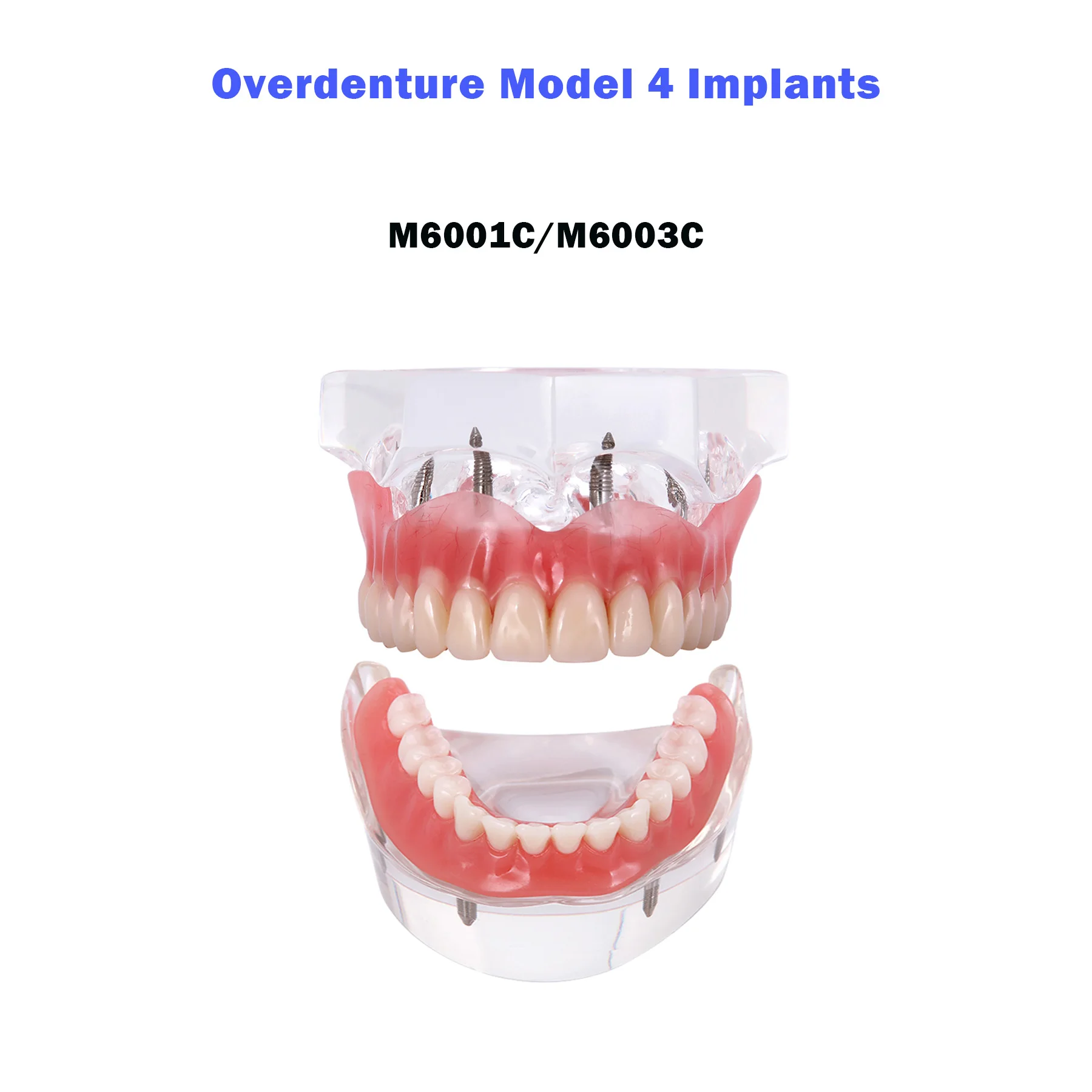 

Dental Teeth Model With 4 Implants Overdenture Removable Bridge For Dentist Patient Communication Demo