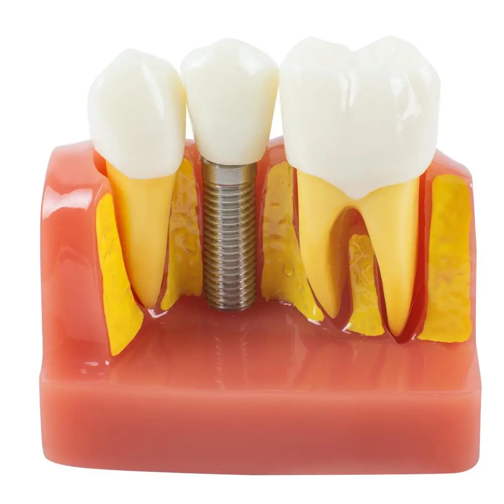 Modèle d'étude dentaire avancé avec modèle de dents parfaites, idéal pour les dentistes, analyse d'implant, démonstration de couronne et de pont