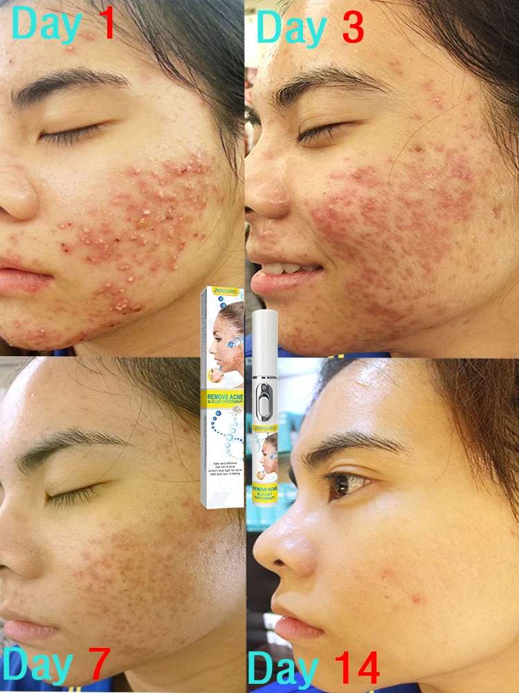 ตัวชี้เลเซอร์กำจัดสิวอย่างรวดเร็วกำจัดสิวบนใบหน้า