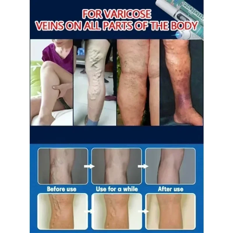 Rivelare le gambe stanche e doloranti |   Laser medico per vene varicose e ragno |   Stimolare il flusso sanguigno: anche sulle pelli sensibili