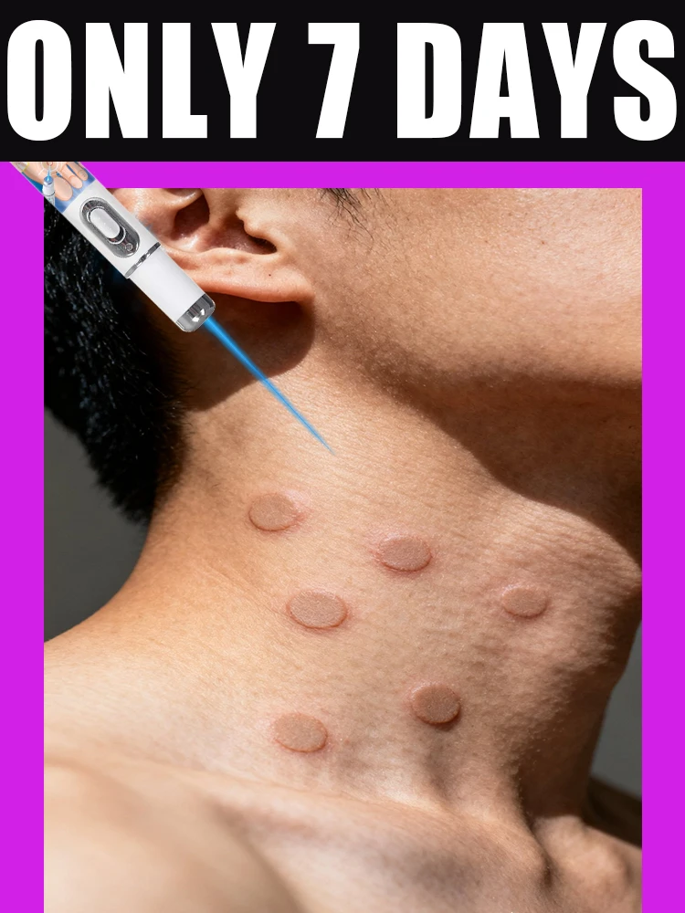 

Blue laser wart pen get off wart gentlely for skin at home use