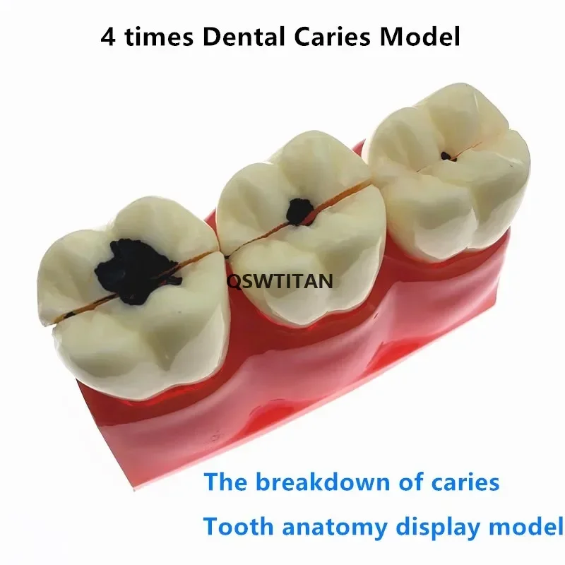

1 Piece 4:1/6:1 Size Dental Caries Removable Teeth Tooth Model Learn Study Model