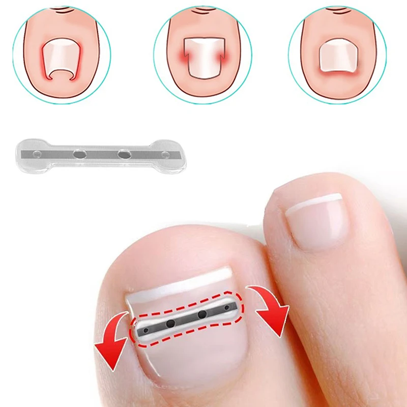 Ingrown Toenail Correction Tool Ingrown Toe Nail Treatment Elastic Patch Sticker Straightening Clip Brace Pedicure Tool