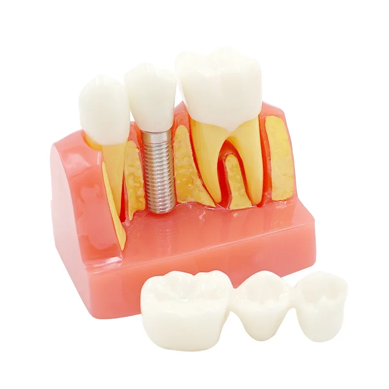 Dental 4 times planting Teeth model Analysis Crown Bridge Removable Model Dental Demonstration Teeth Model