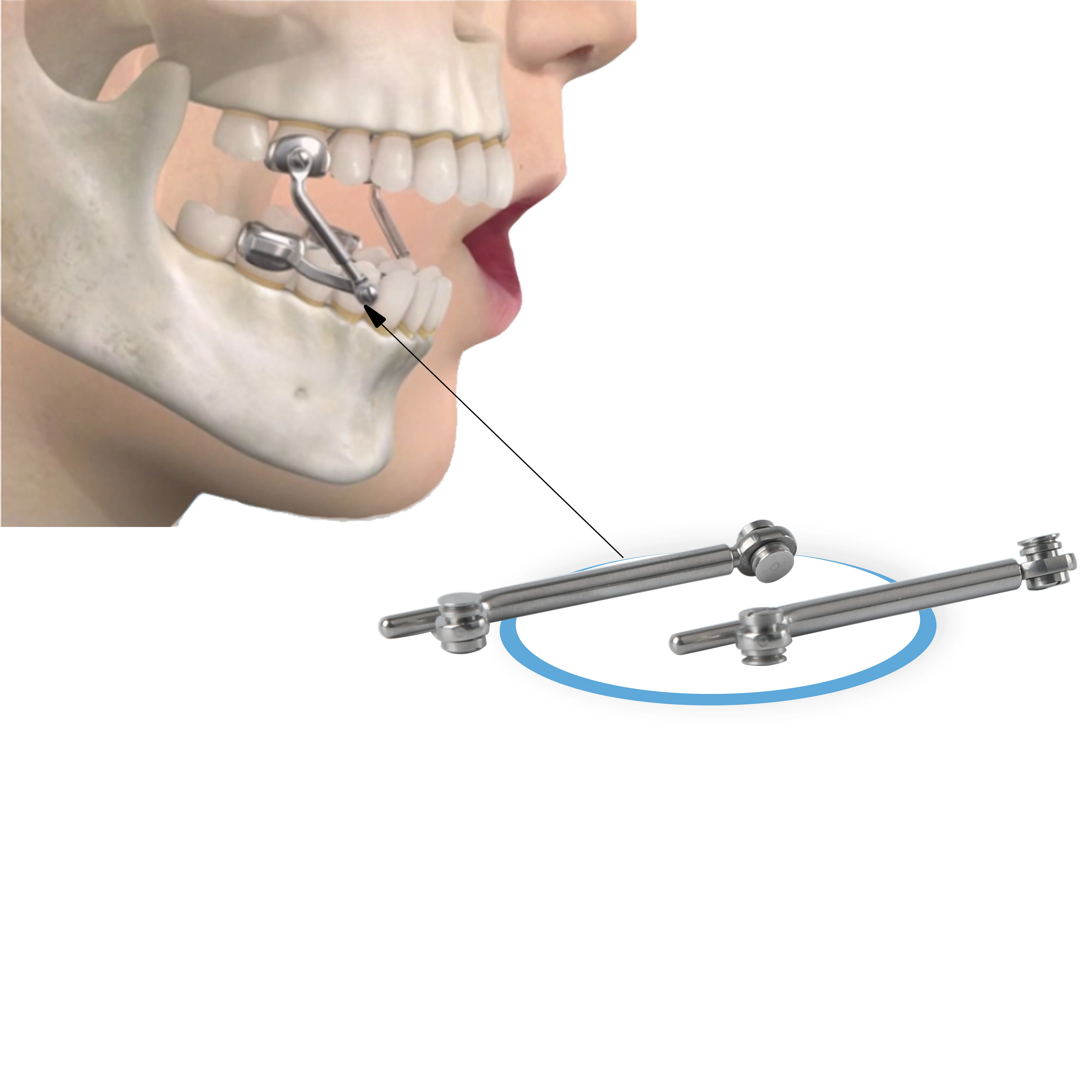Buccal Mounted Herbst Appliance Fixed Non-Removable with Occlusal Bite Jump for Class II Correction Precision Orthodontic Device