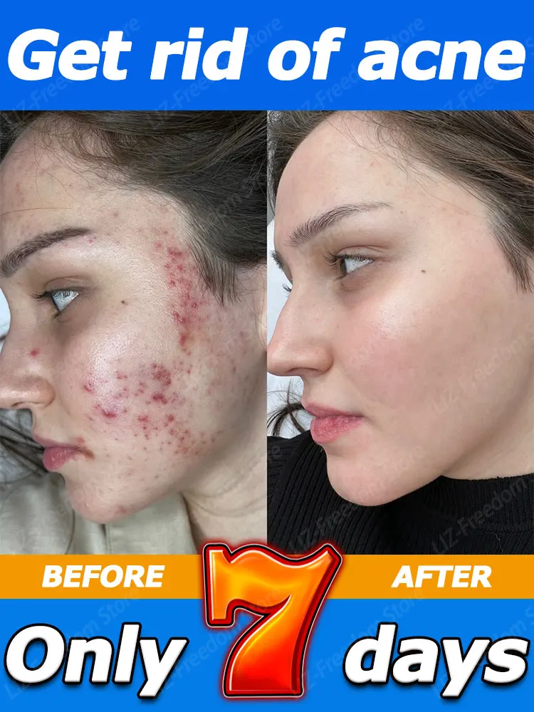 Cuidados com a pele anti acne