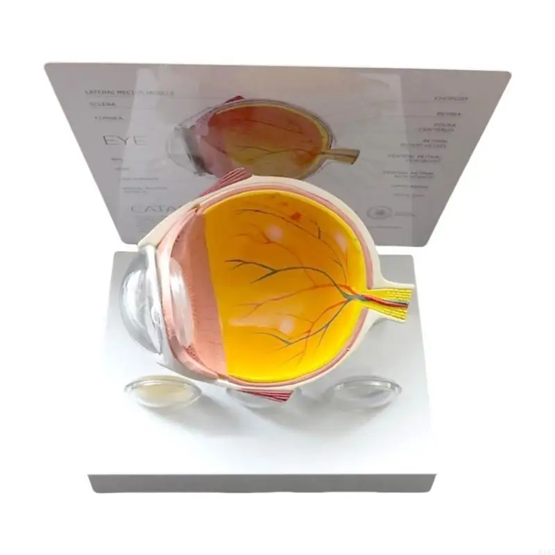 Menschliches pathologisches Augapfel Modell pathologisches Augapfel -Anatomie -Modell zum Unterrichten von Demonstration