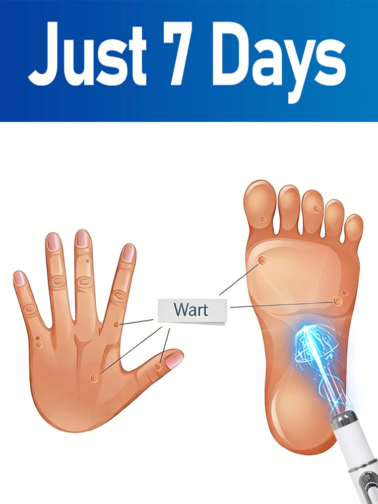 

Доверьтесь ручке с синим светом, перестаньте беспокоиться о бородавках. Инструменты для ухода за ногами.