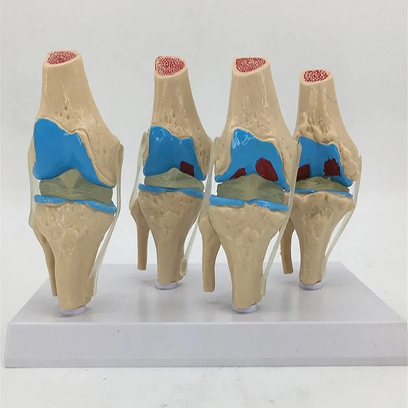 1PC Anatomical Human Knee Joint Model Human Stage 4 Knee Joint Model for School Teaching Display Models Disease Process