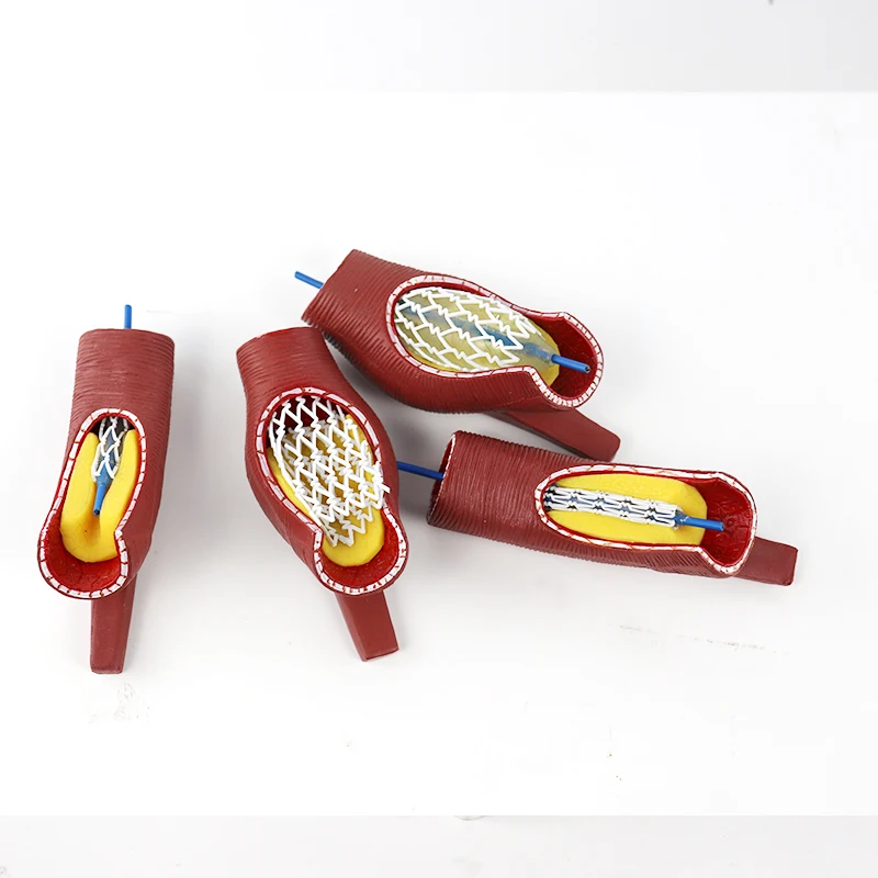 Coronary Stent Enlargement Model for Vascular Blockage Training Medical Education Aid