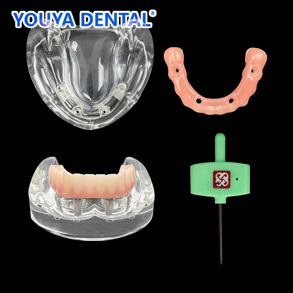 Lower Dental Teeth Model Overdenture Superior 4 Implants Dentist Patient Restoration Demo Communication Model For Student