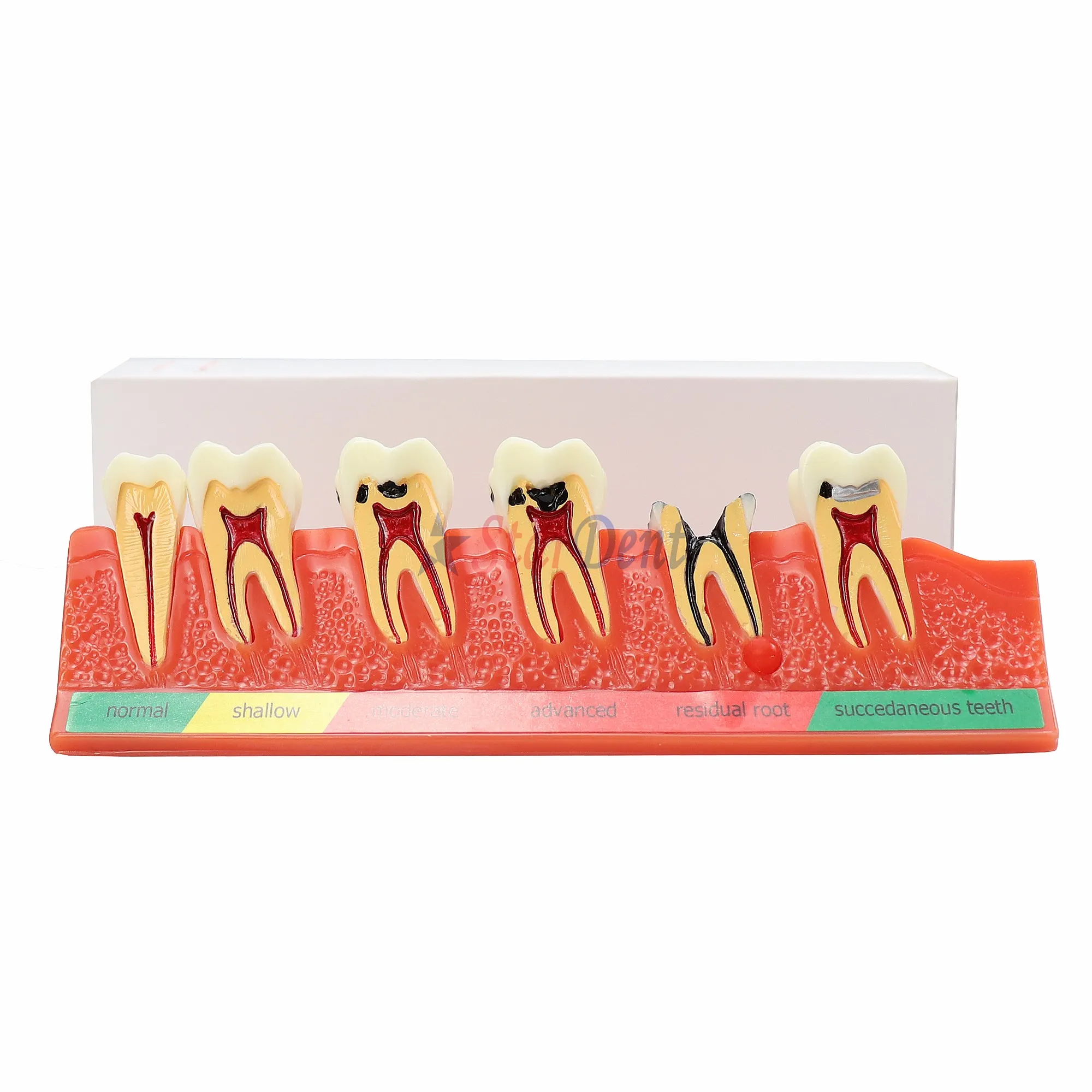 Bulk Supply New Arrival Dentals Caries Illustration Model Teeth Teaching Student Education