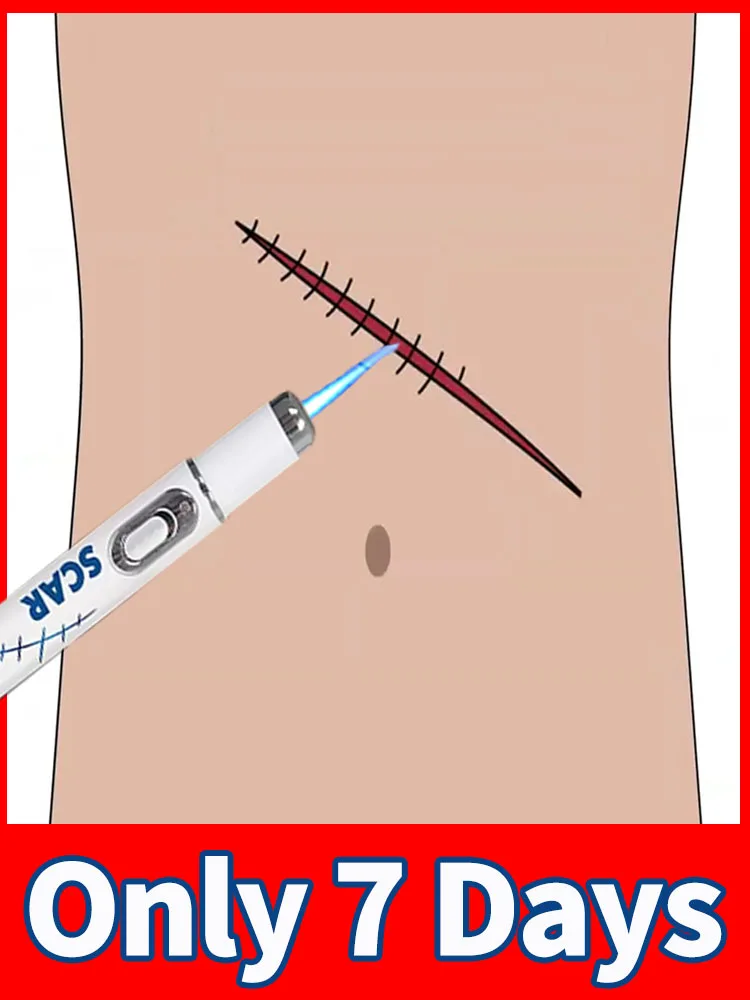 

Quick Solve Scar Laser Remove For All Kinds Of Scars Painless