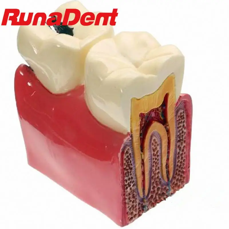 

Dental Teaching Model Dental Materials Lab Teeth Model 6 Times Caries Comparation Study Models