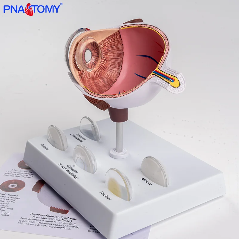 Pathological Eye Model Eye Model Corneal Disease Eye Model