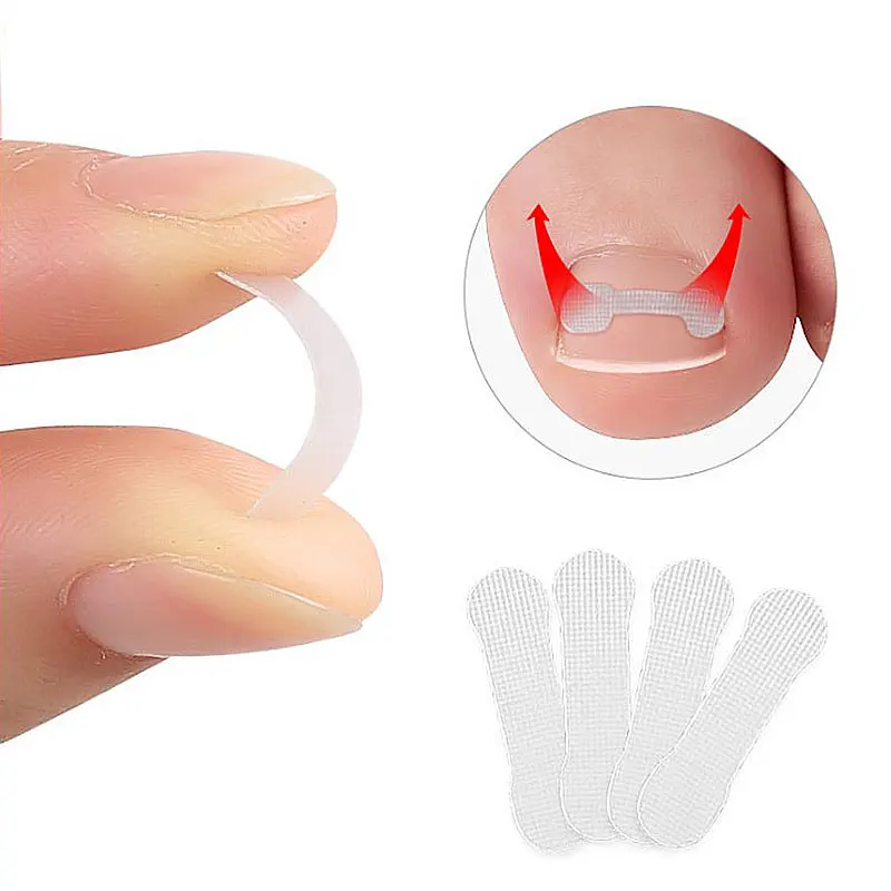 

10/20/30Pcs Ingrown Toe Nail Treatment Ingrown Toenail Correction Elastic Patch Sticker Straightening Clip Brace Pedicure Tools