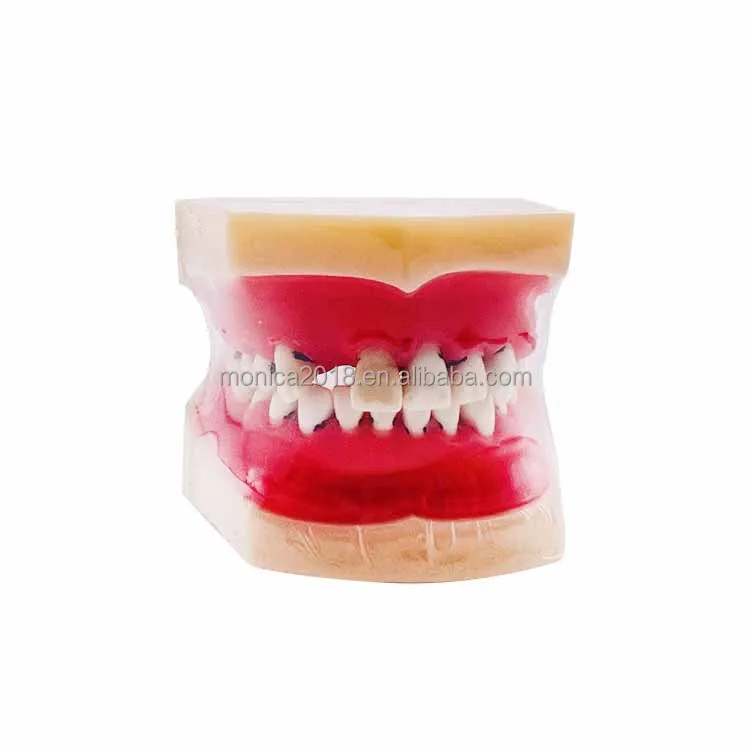 den tal Periodontal Disease Model Teeth Anatomical Pathology Model Tooth den tal Human den tal Care Model