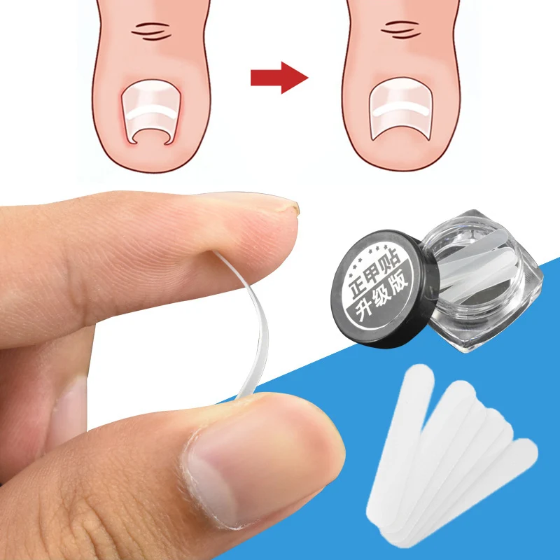 10pcs Ingrown Toe Nail Treatment Ingrown Toenail Correction Tool Elastic Patch Sticker Straightening Clip Brace Pedicure Tools
