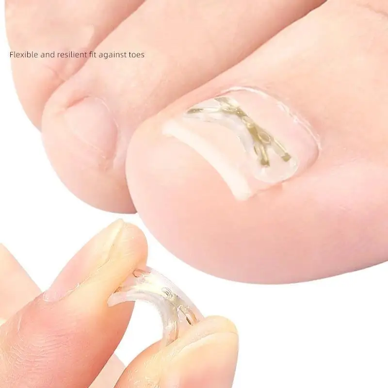Ingrown Toenail Corrector Patches 13-17mm Gentle Paronychia Treatment Foot Care Product for Sensitive Skin Users