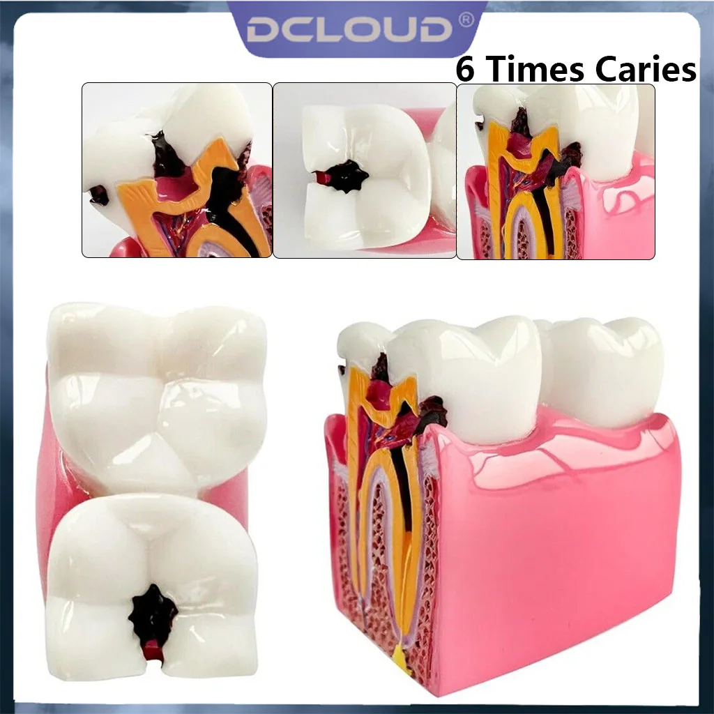 6 Times Study Models Dental Caries Comparsion Teeth Models for Dentist Studying Teaching Anatomy Practice Dentistry Tooth Model